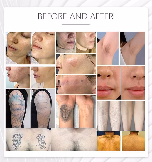 2023 M22 IPL Opt Skin Photon Rejuvenation Beauty Equipment Aopt Laser M22 Lumenis Resurfx Cool Hair Removal Machine